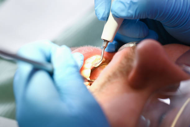 Best Emergency Dental Care for Abscessed Tooth in St Bonaventure, NY