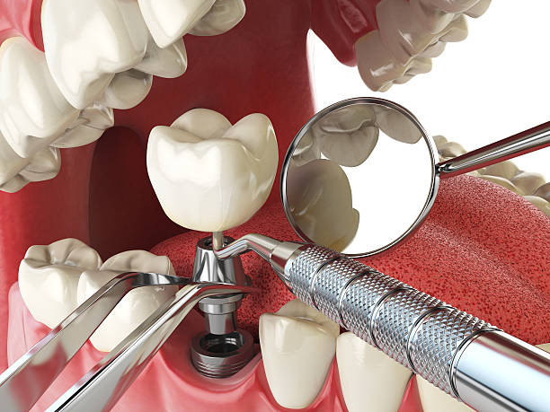 Best Broken or Cracked Tooth Emergency Dentist in St Bonaventure, NY
